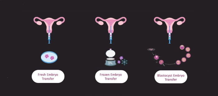 embryo transfer