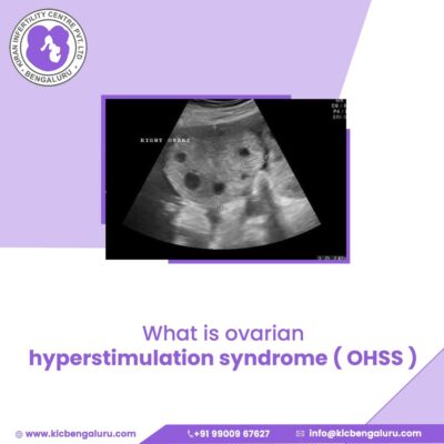 What is ovarian hyperstimulation syndrome